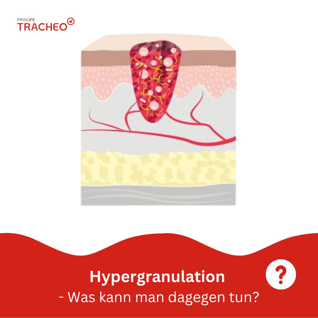 Hypergranulation
