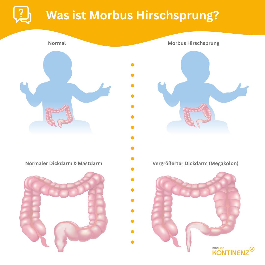 Morbus Hirschsprung