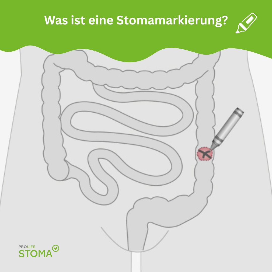 Stomamarkierung