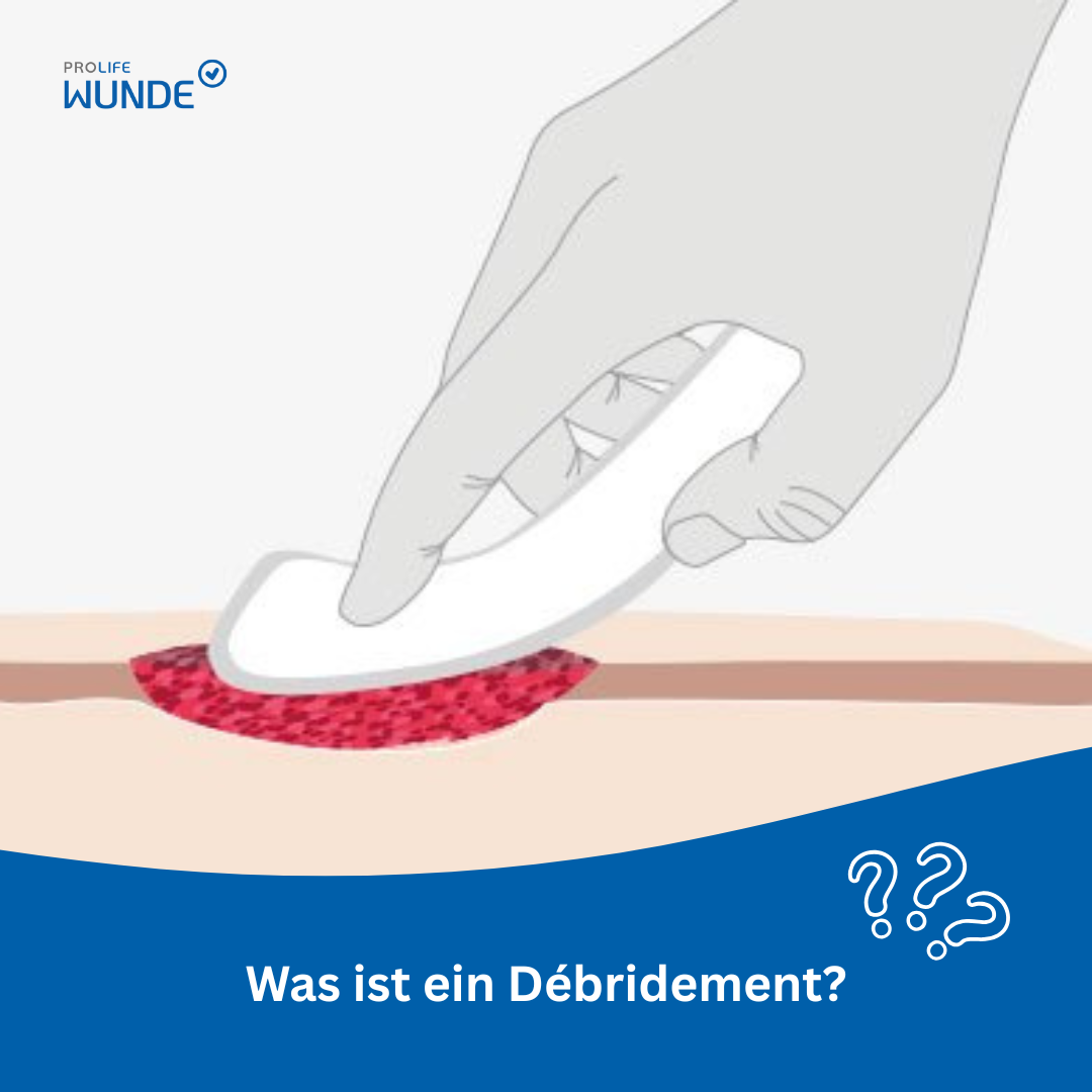 Definition Débridement