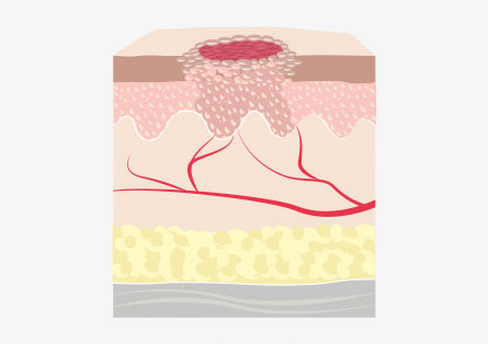 Epithelisierung