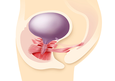 Beckenbodensenkung
