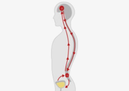 Neurogene Blase