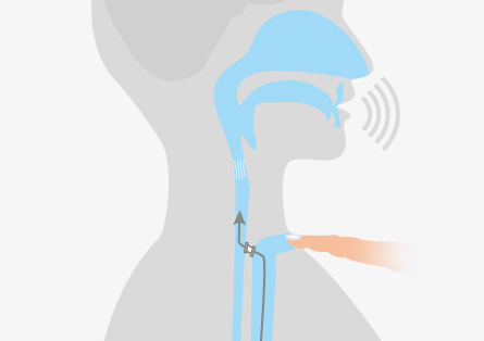 Stimmprothese