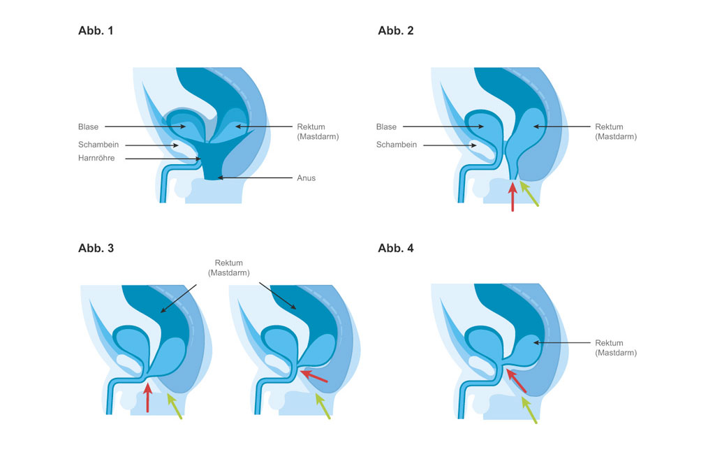  Unterschiedliche Formen der Analatresie bei Jungen © Bilder modifiziert aus Ashcraft's Pediatric Surgery, 5th edition