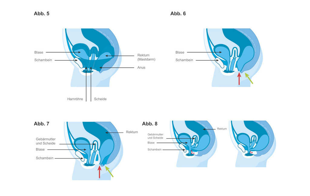 Unterschiedliche Formen der Analatresie bei Mädchen © Bilder modifiziert aus Ashcraft's Pediatric Surgery, 5th edition