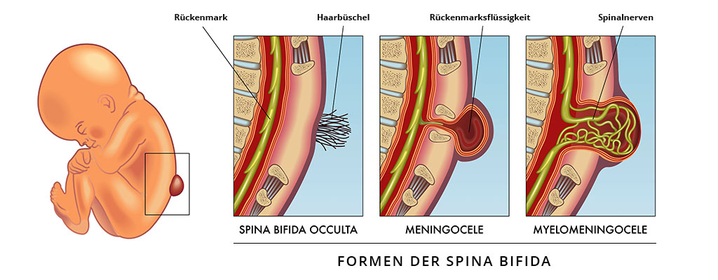 Formen der Spina bifida
