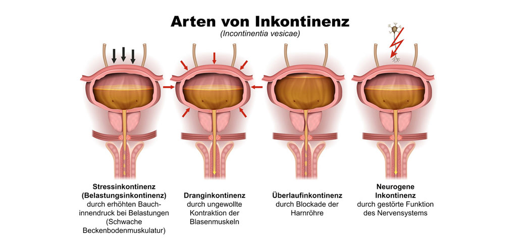 Grundformen der Harninkontinenz im Überblick © bilderzwerg/fotolia.com 