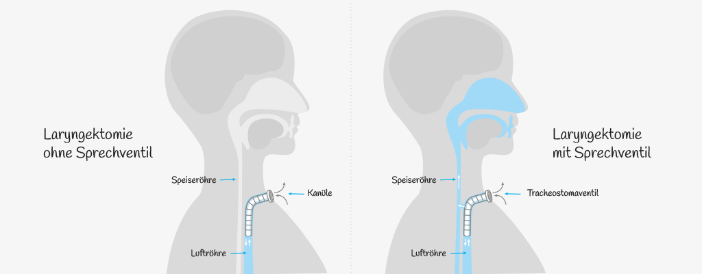 Abb. 1 Luftfluss nach einer Laryngektomie ohne und mit Stimmprothese