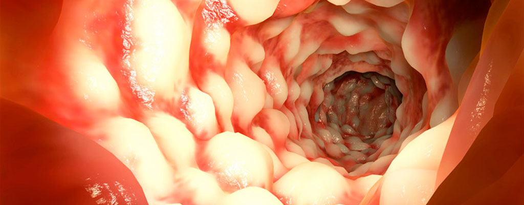 Blick in den Darm. Typisches Pflasterstein-Relief-Erscheinungsbild der Schleimhaut des Darms bei Morbus Crohn. © Juan Gärtner/fotolia.com