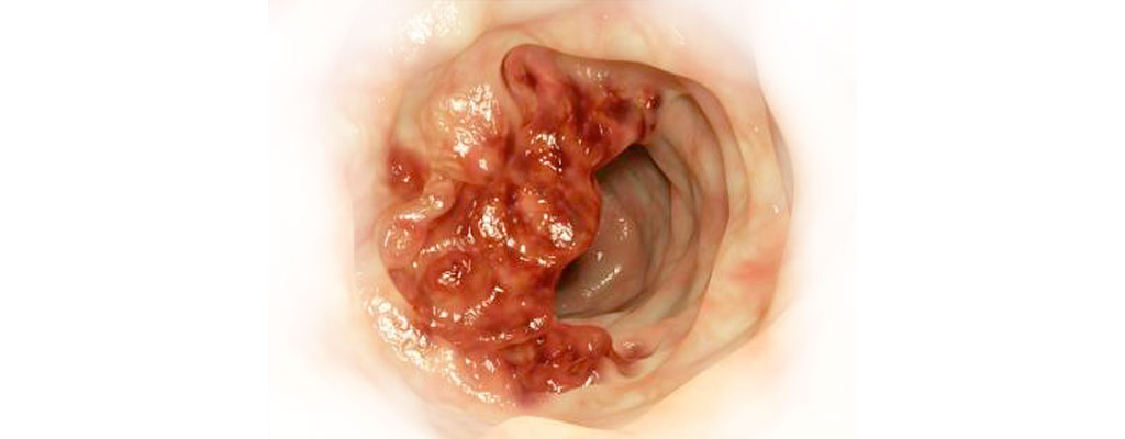 Endoskopische Darstellung eines Darmtumors. Er wächst in den Darm hinein und engt damit das Lumen ein. © Juan Gärtner/fotolia.com