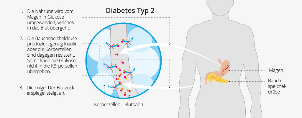 Wirkungsweise Typ 2 Diabetes